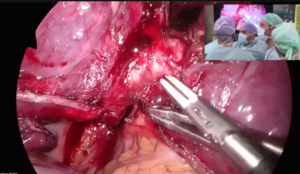 BME Day 2021 Live surgery lung resection (cancer)